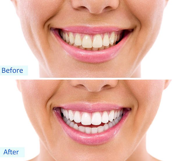Smile Designing